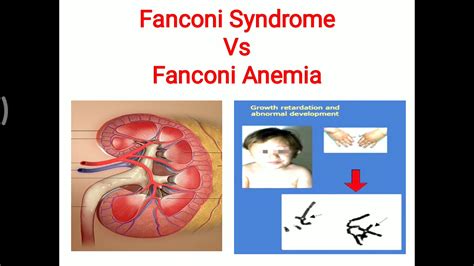 fendi syndrome|fanconi syndrome in adults.